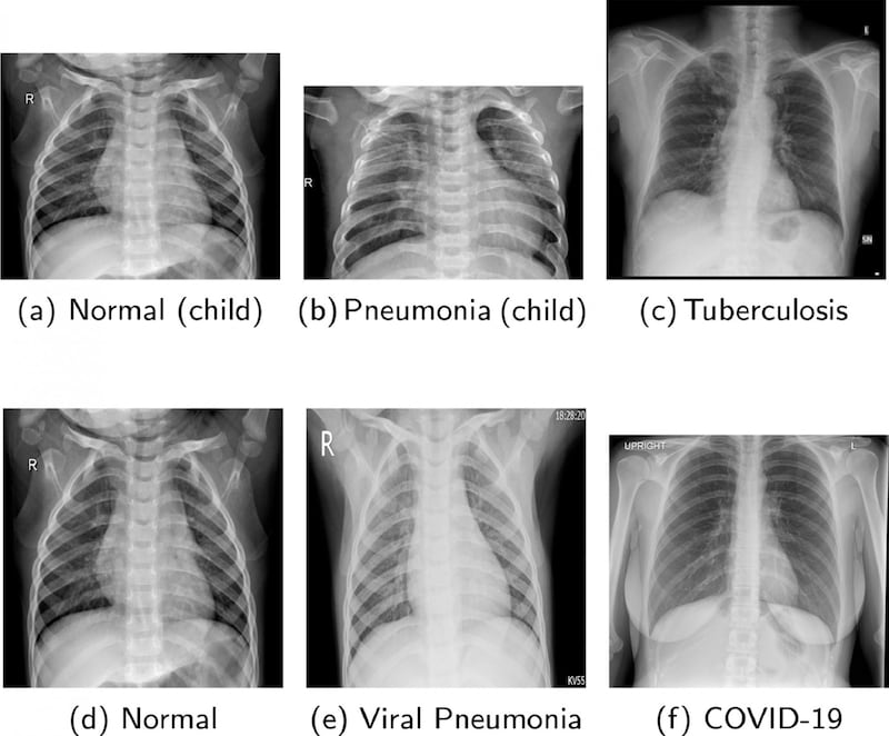 Inteligencia Artificial para la detección de enfermedades pulmonares