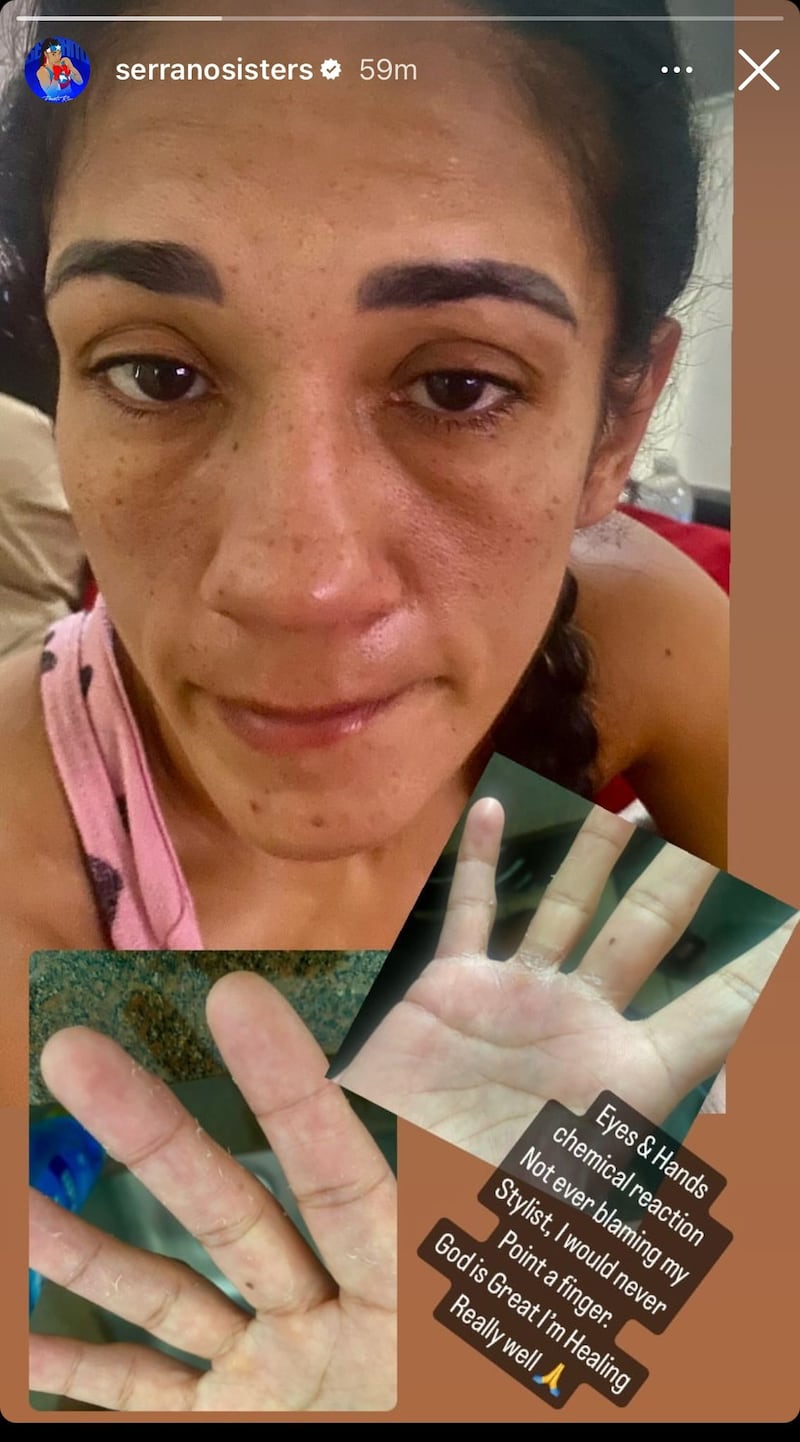 Amanda Serrano muestra los efectos del producto que afectó su rostro